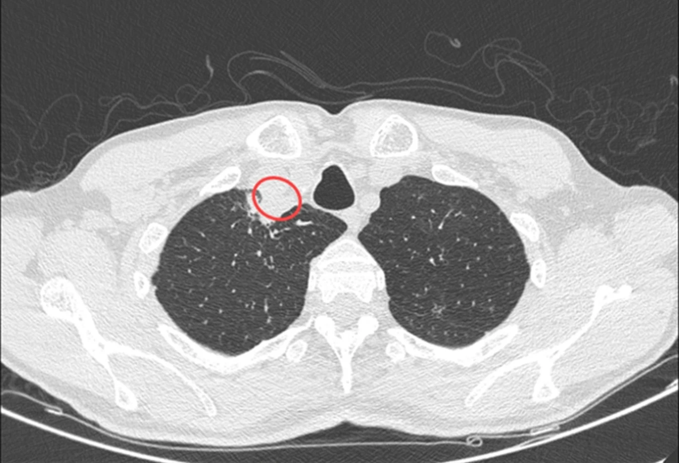 U 61-latka z Indii podczas tomografii wykryto ropień w okolicach tchawicy. Po wielu badaniach okazało się, że jest on wynikiem zakażenia grzybicznego U 61-latka z Indii podczas tomografii wykryto ropień w okolicach tchawicy. Po wielu badaniach okazało się, że jest on wynikiem zakażenia grzybicznego