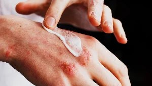 Dla suchej skóry nie ma nic lepszego. Kupisz w każdej aptece i nie pożałujesz