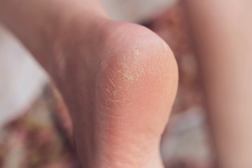 Jak dbać o skórę na stopach? 5 kroków do idealnie gładkich stóp
