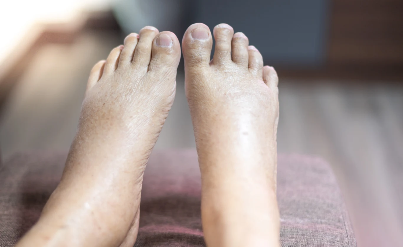 W niewydolności lub chorobach wątroby pojawia się opuchlizna na stopach, kostkach ale także twarzy