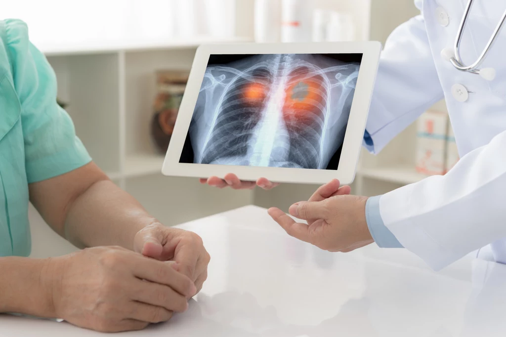 Model AI został przetestowany w celu określenia, czy może pomóc w diagnostyce onkologicznej Model AI został przetestowany w celu określenia, czy może pomóc w diagnostyce onkologicznej