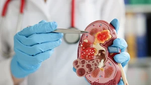 Bóle pleców i osłabienie są mylące. Tak objawia się podstępny rak nerki