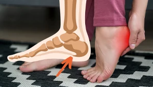 Poznaj sposoby na bolesną piętę bez operacji. Wystarczy kilka minut dziennie