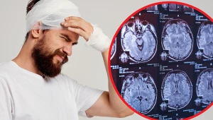 Uderzyłeś się w głowę? Objawy wstrząśnienia mózgu nie są takie oczywiste