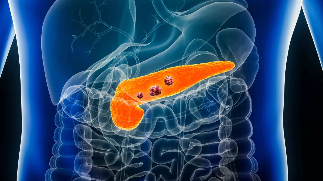 FDA zatwierdziła daraxonrasib (Rasonque). Terapia niemal dwukrotnie wydłuża czas przeżycia pacjentów Schemat tułowia z zaznaczoną na pomarańczowo trzustką i widocznymi ciemnymi zmianami nowotworowymi.