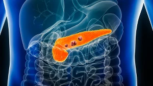 FDA zatwierdza daraxonrasib. Nowa terapia dla pacjentów z rakiem trzustki