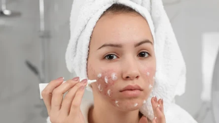 Maść cynkową na trądzik należy stosować punktowo