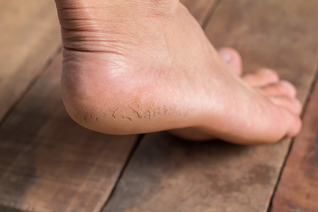 Istnieje kilka domowych trików, które zabezpieczą skórę stóp przed pękaniem 