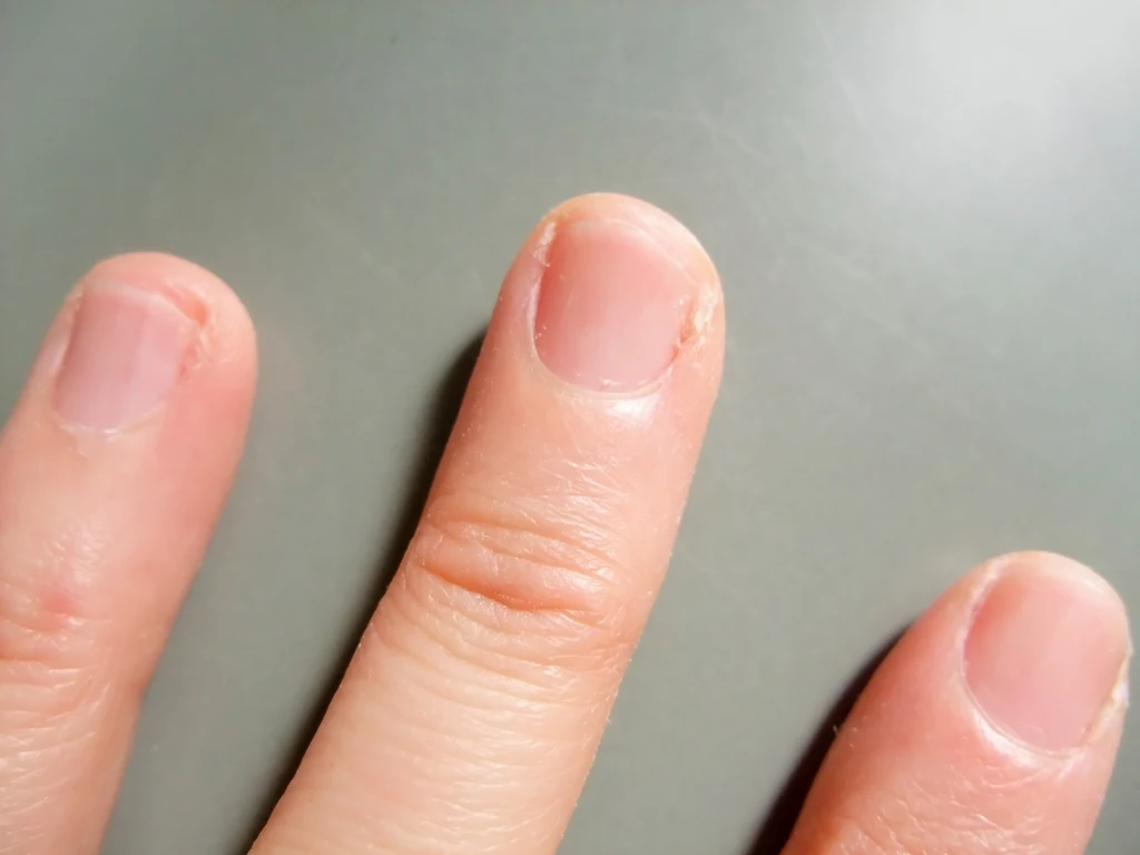 Nagła zmiana kształtu paznokci powinna być powodem do niepokoju 