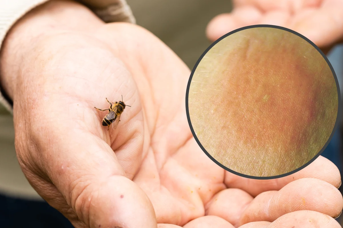 Po użądleniu przez pszczołę, w miejscu ukłucia pozostaje żądło, które należy usunąć /SuperManu/Wikimedia