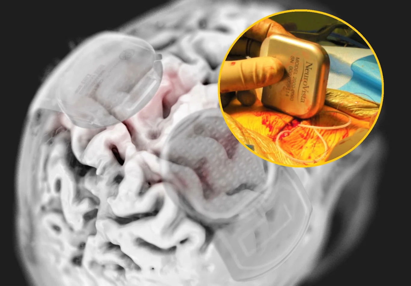 Producent implantu elektronicznego wszczepionego do mózgu zbankrutował, co spowodowało dramat pacjentów Producent implantu elektronicznego wszczepionego do mózgu zbankrutował, co spowodowało dramat pacjentów