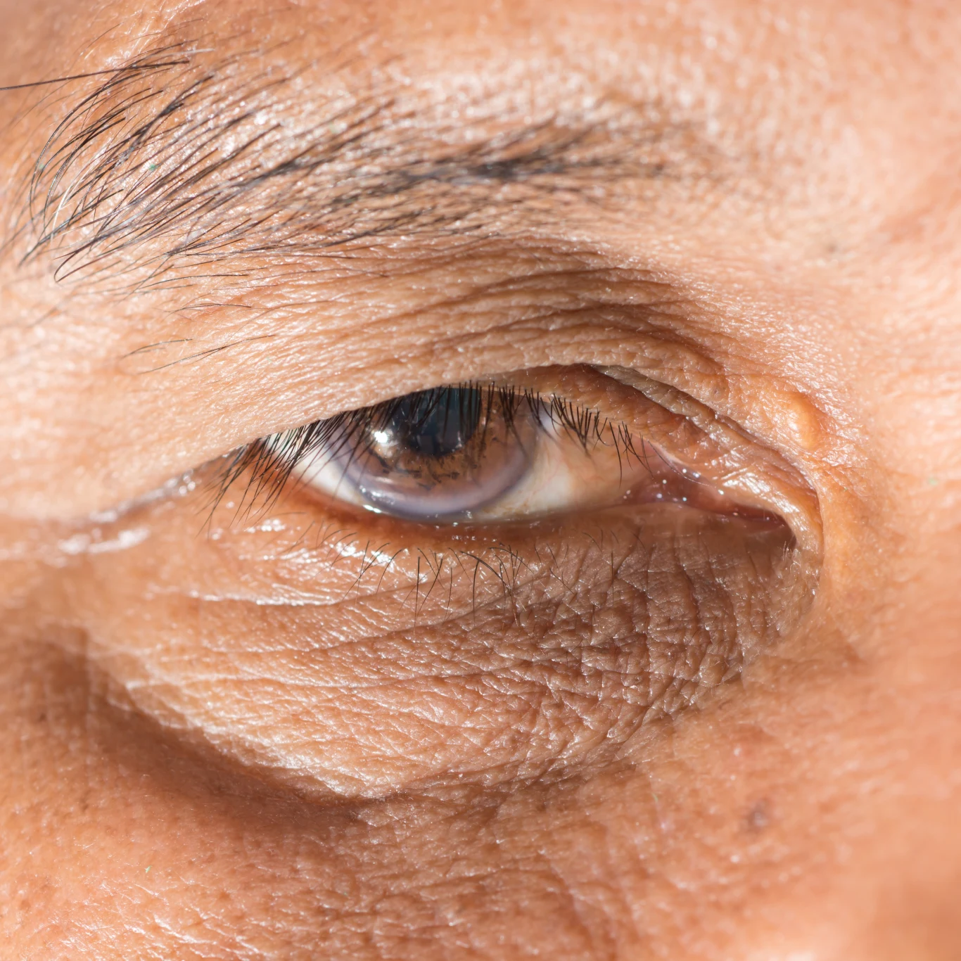 Wielu uważa, że ptoza to efekt starzenia się, jednak jej pojawienie się może mieć wiele innych przyczyn