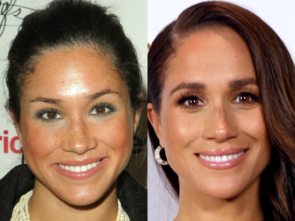 Meghan Markle: przed i po operacji nosa - według chirurga Vartana Mardirossiana Meghan Markle: przed i po operacji nosa - według chirurga Vartana Mardirossiana