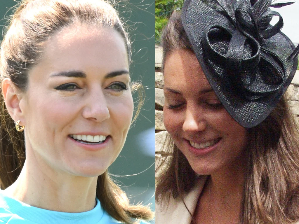 Kate Middleton miała zbotokoswać czoło Kate Middleton miała zbotokoswać czoło