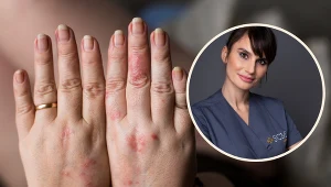 Lek. Anna Bachleda-Curuś, dermatolog, wylicza produkty, które zaostrzają choroby skórne /materiały prasowe