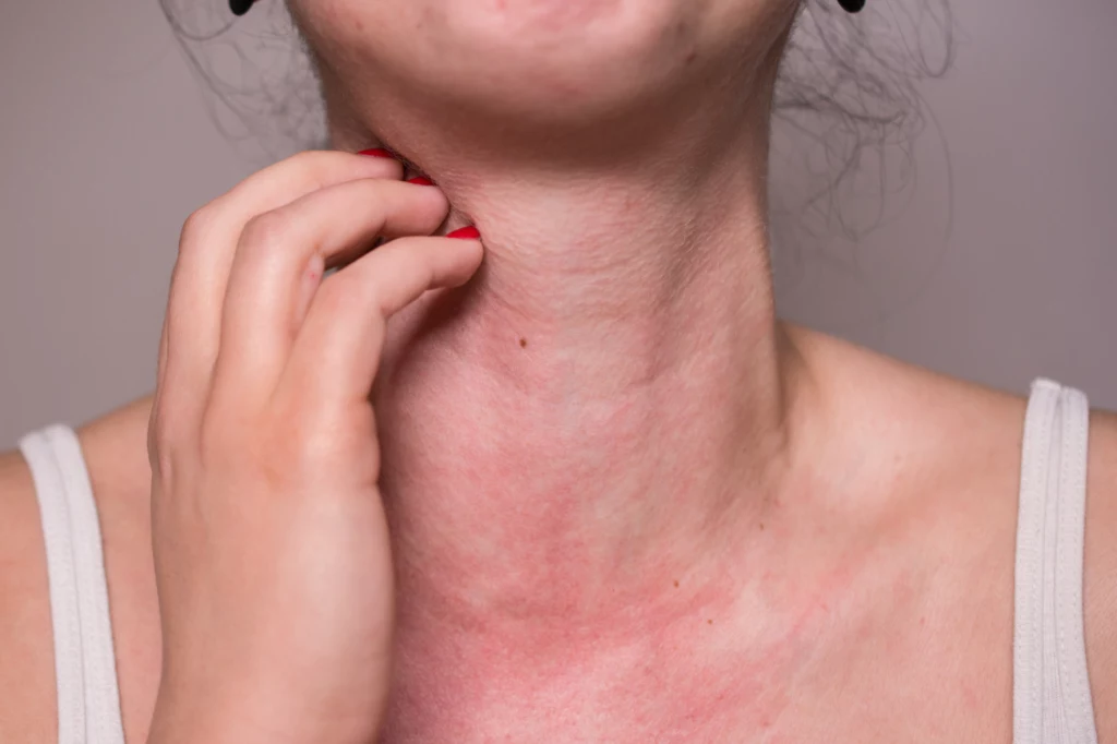 Alergia na słońce może objawić się wysypką na szyi 