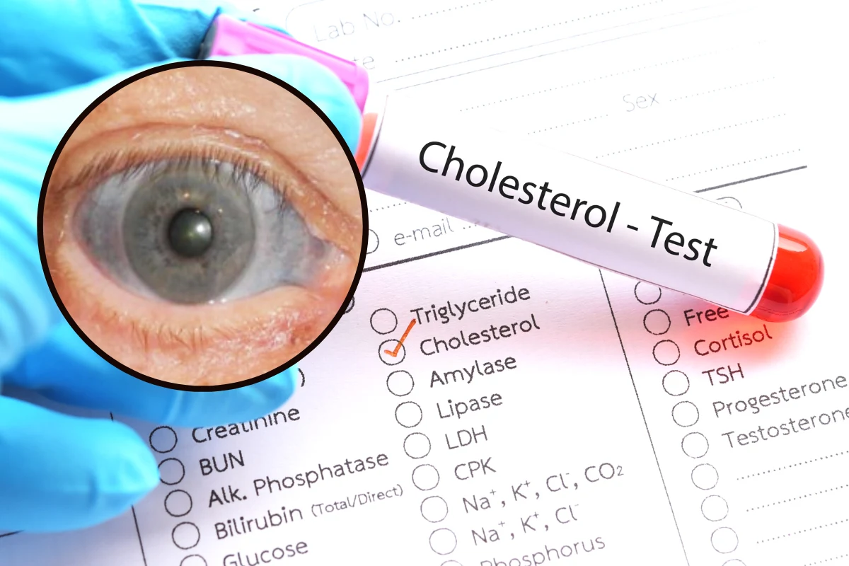 Wysoki cholesterol nie boli, ale wysyła wiele sygnałów, dostrzegalnych na całym niemalże ciele