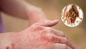 Alergia pokarmowa - to te produkty uczulają najczęściej. Jeden może zaskoczyć