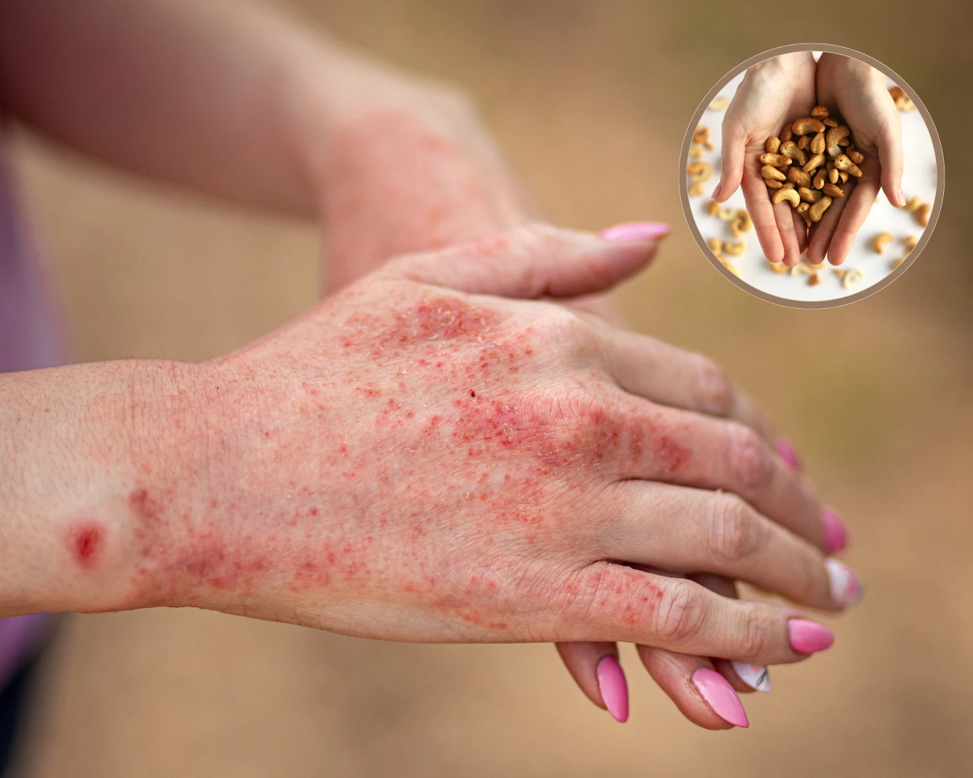 Alergia pokarmowa dotyka wielu osób. Co ją wywołuje?