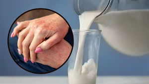 Skaza białkowa manifestuje się głównie zmianami skórnymi. Może być mylona z AZS, łuszczycą lub odrą