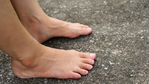 Asfaltówka - to wysypka, której można nabawić się podczas aktywności na słońcu