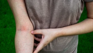  Meszki, czyli małe, niepozorne owady, mogą być wyjątkowo uciążliwe. Jakie objawy mogą pojawić się po ugryzieniu?