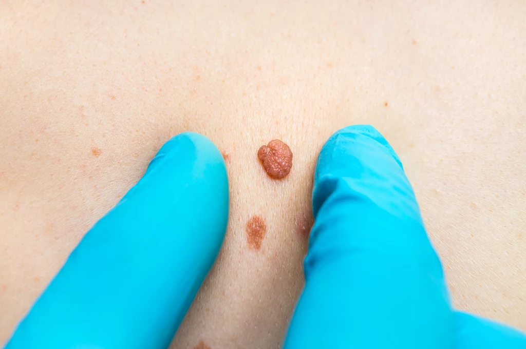 Osoby, u których istnieje zwiększone ryzyko wystąpienia czerniaka, powinny raz w roku udać się do dermatologa