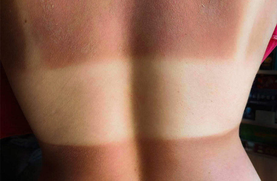 oparzenia słoneczne skóry bywają bolesne