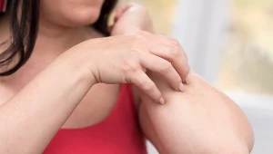 Nietolerancję histaminy zdradzi m.in.: biegunka, swędzenie skóry, 
wzmożone pragnienie czy katar