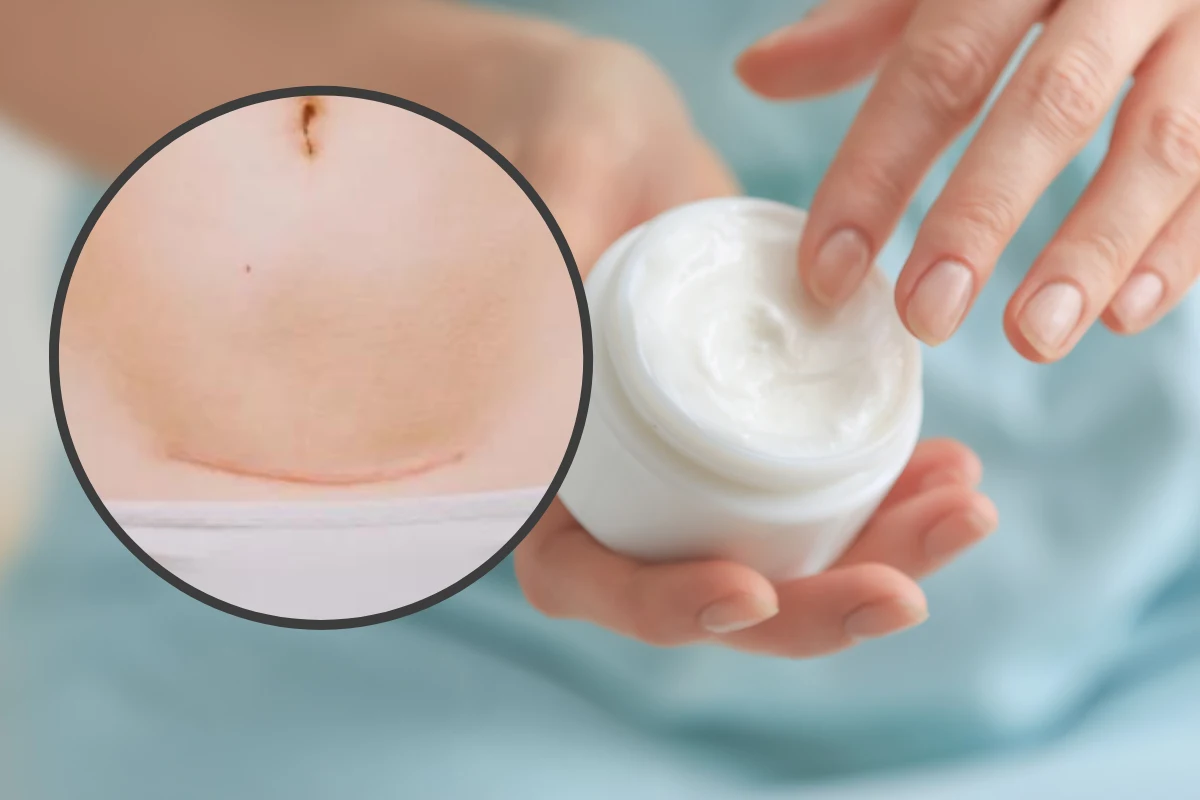 Zabiegi, które przywrócą skórze na brzuchu jędrność i napięcie możesz rozpocząć dopiero po zdjęciu szwów 