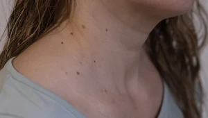 Tak może się objawiać rak tarczycy. Warto zapamiętać zwłaszcza trzy objawy