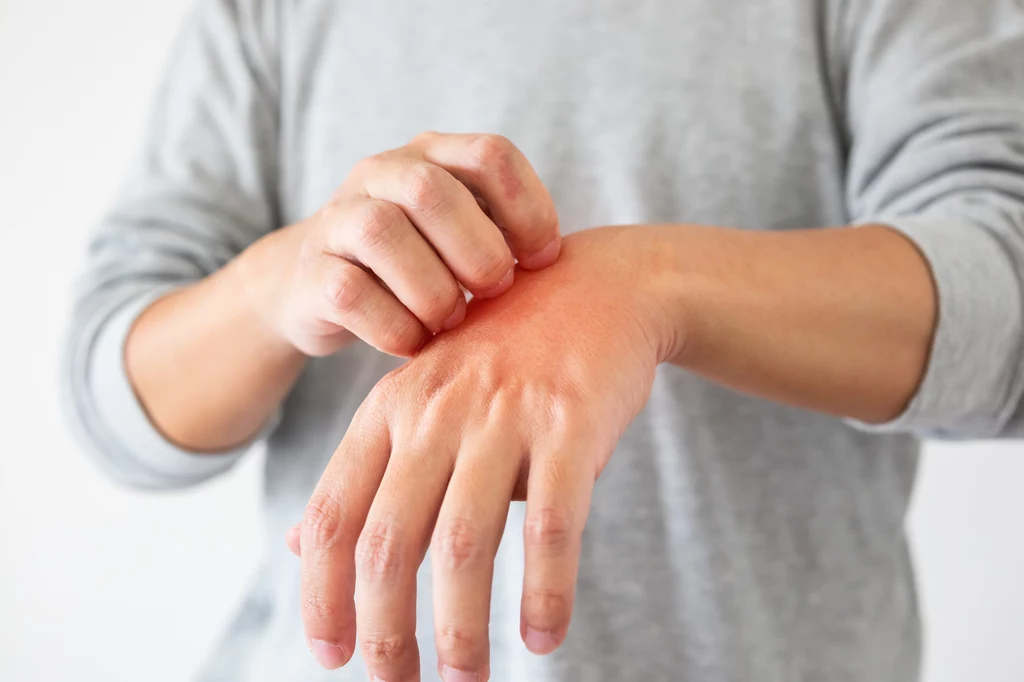 Jak dbać o dłonie, gdy swędzą?