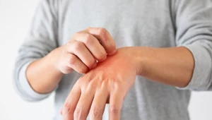Nigdy nie ignoruj swędzących dłoni. Mogą sygnalizować poważne choroby