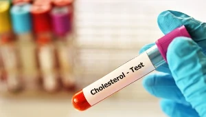 Wysoki cholesterol nie boli, ale wysyła sygnały. Są na oku, ustach, stopach