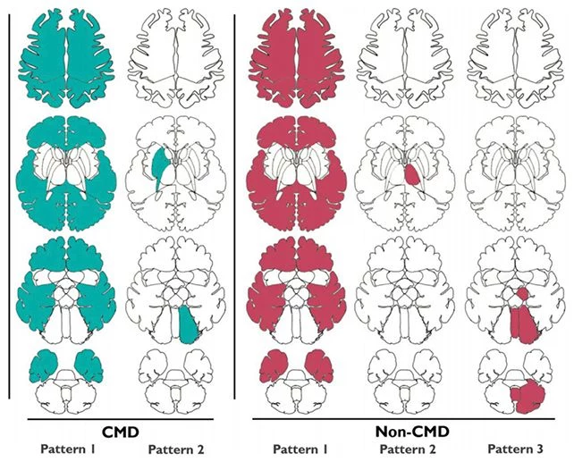 Porównanie wzorców mózgowych osób z CMD i bez CMD