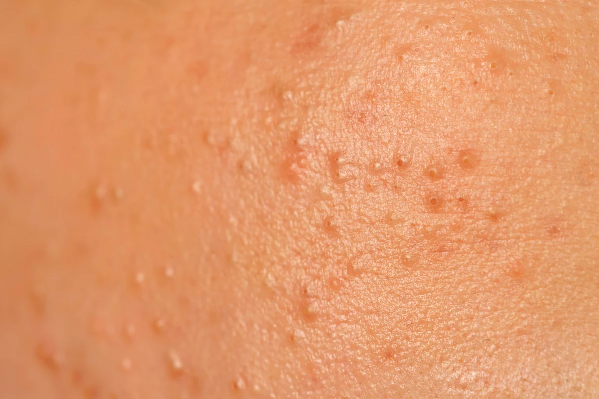 Trądzik jest trudnym do wyleczenia schorzeniem