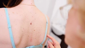 Zaniepokoiła cię zmiana na skórze? Nie zwlekaj z wizytą u specjalisty!