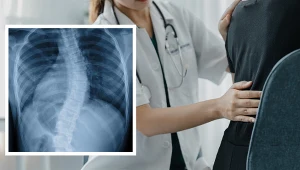 Wystająca łopatka i pochylenie postawy to objawy. Konieczna bywa operacja