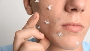 Nie każdy trądzik da się pokonać drogeryjnym kremem – czasem skóra potrzebuje czegoś mocniejszego