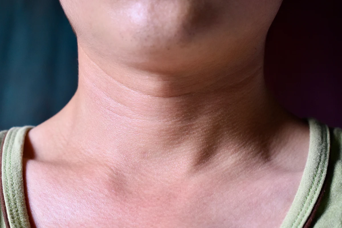 Zmiany w kształcie i wielkości tarczycy można niekiedy zaobserwować gołym okiem. Jeśli coś cię zaniepokoi, koniecznie skonsultuj się z lekarzem