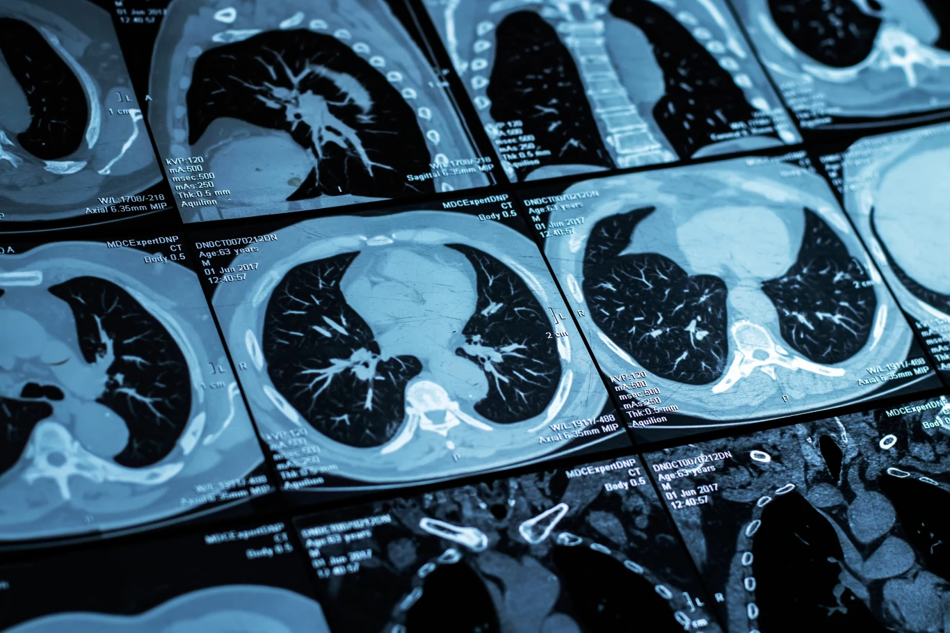 Tomografia płuc służy zarówno do wstępnej diagnostyki, jak i monitorowania przebiegu choroby Tomografia płuc służy zarówno do wstępnej diagnostyki, jak i monitorowania przebiegu choroby