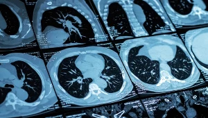 Jedno badanie płuc może wyjaśnić wiele objawów. Wykryje raka i stan zapalny