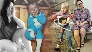 Iwona choruje na tibial hemimeli, ale czerpie z życia pełnymi garściami 