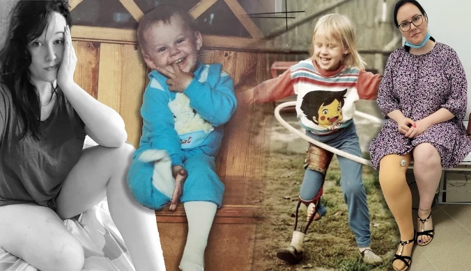 Iwona choruje na tibial hemimeli, ale czerpie z życia pełnymi garściami 