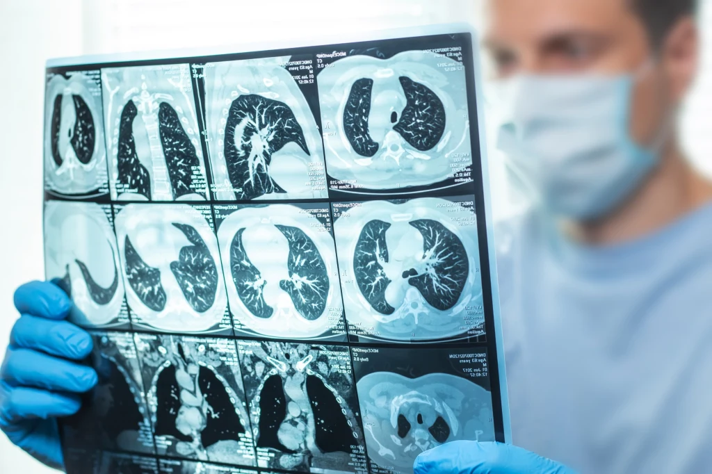 Nagłe uczucie duszności to jeden z pierwszych objawów zamknięcia tętnicy płucnej