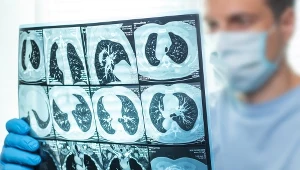 Zator w tym miejscu jest śmiertelny. Duszność to tylko jeden z objawów