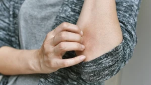 Siniaki powstające nawet przy niewielkich urazach mogą być objawem niedoboru witaminy K