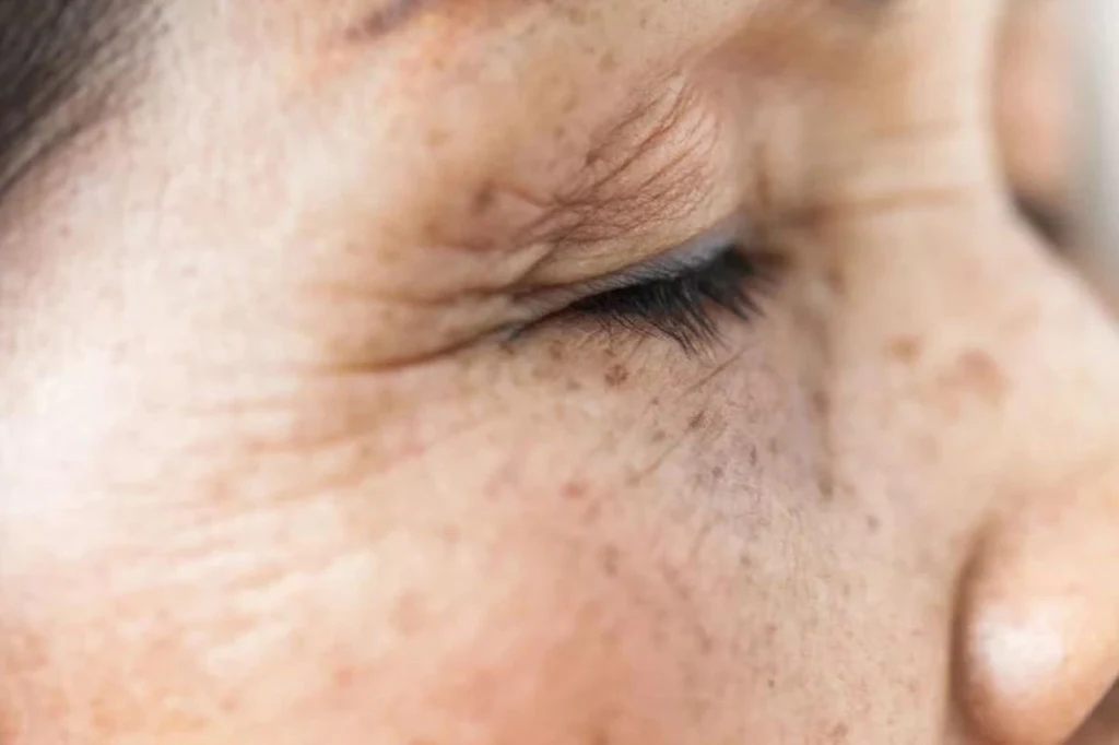 Plamy wątrobowe, nazywane także starczymi, mogą wystąpić u osób w każdym wieku Plamy wątrobowe, nazywane także starczymi, mogą wystąpić u osób w każdym wieku