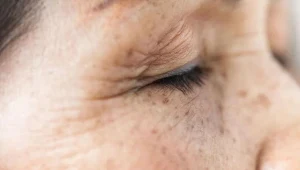 Plamy wątrobowe, nazywane także starczymi, mogą wystąpić u osób w każdym wieku 