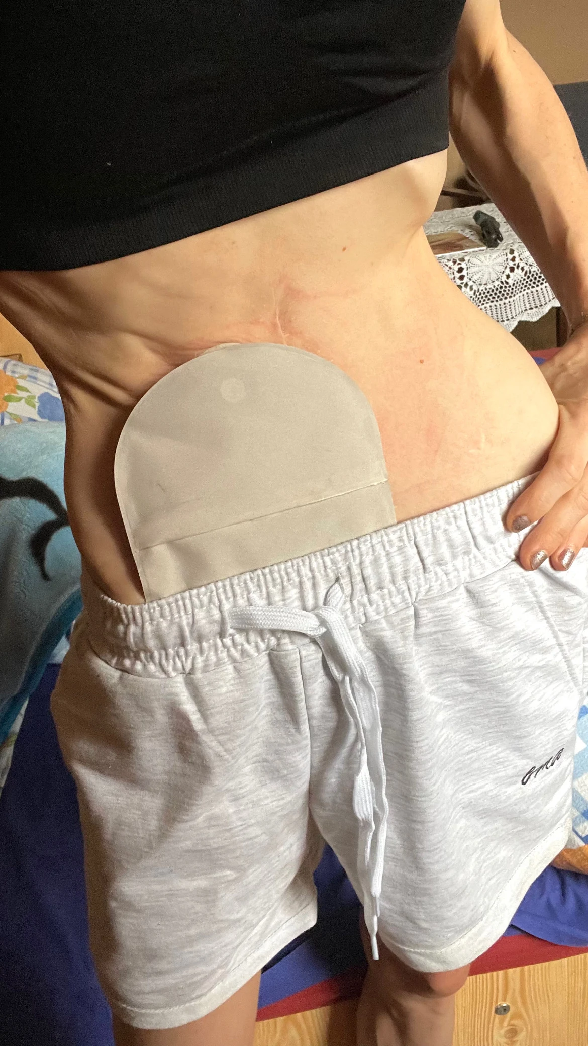 Agata pokazuje jak wygląda życie ze stomią 